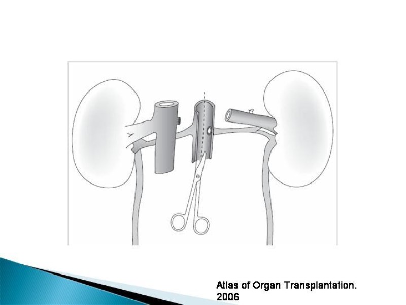 Diapositiva 37 de Técnica de procuramiento renal