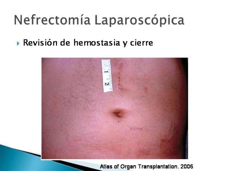 Diapositiva 81 de Técnica de procuramiento renal