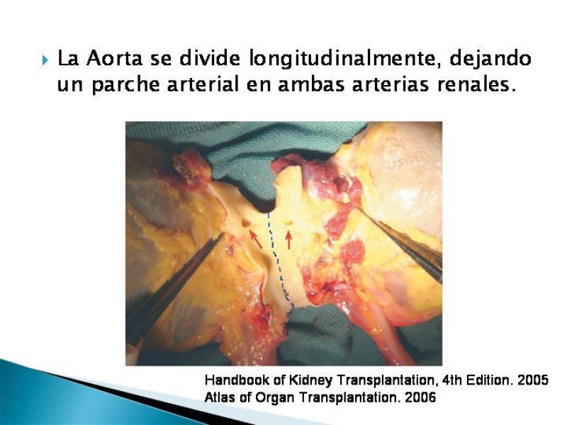 Diapositiva 36 de Técnica de procuramiento renal