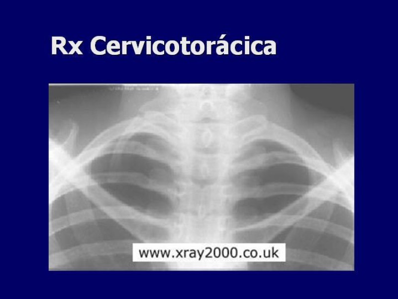Diapositiva 10 de Síndrome del Opérculo Torácico