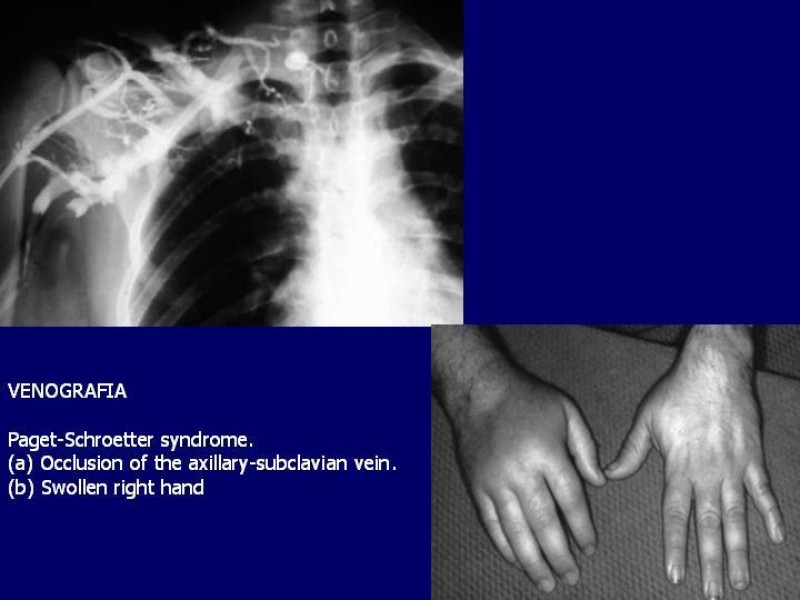 Diapositiva 19 de Síndrome del Opérculo Torácico
