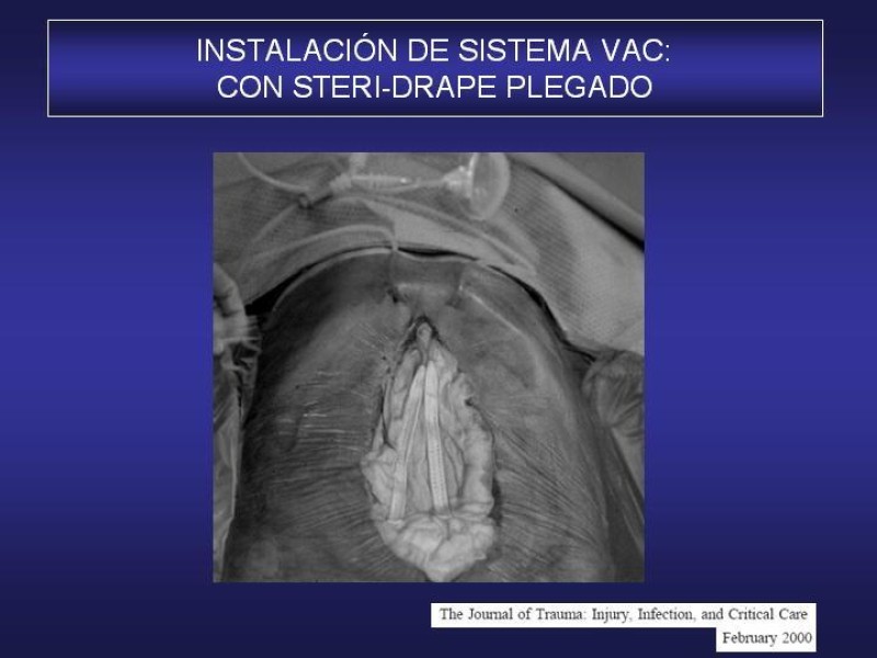 Diapositiva 46 de El Sistema VAC en la laparotomía contenida