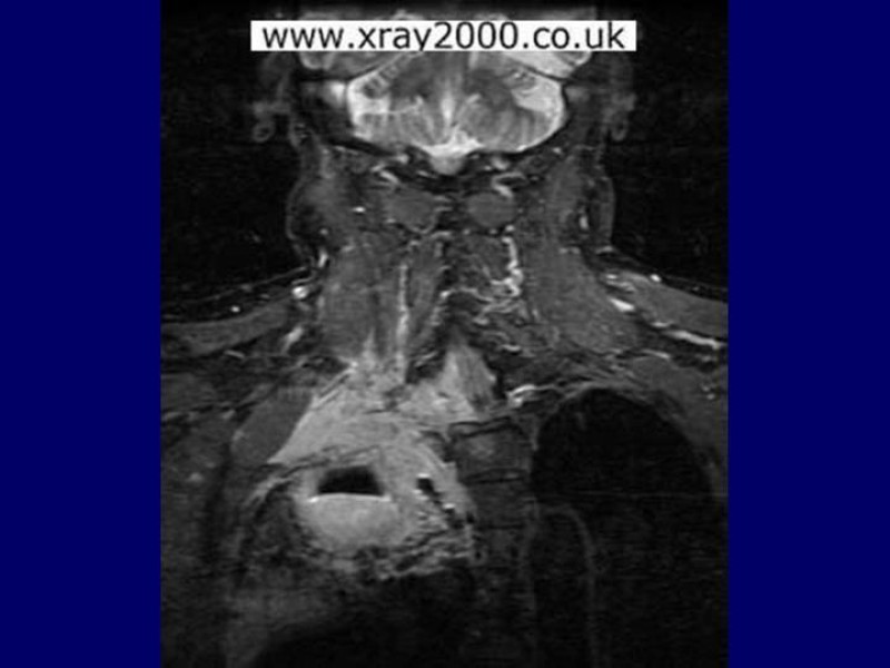 Diapositiva 15 de Síndrome del Opérculo Torácico