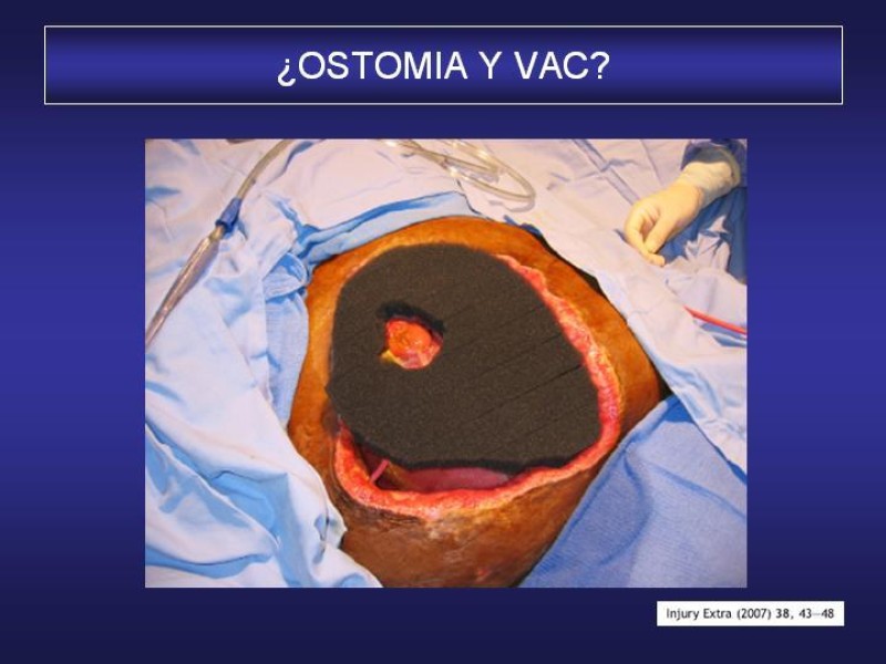 Diapositiva 55 de El Sistema VAC en la laparotomía contenida