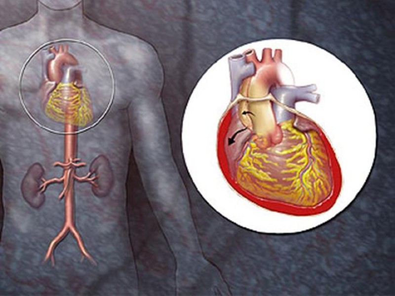 Diapositiva 9 de Disección Aórtica