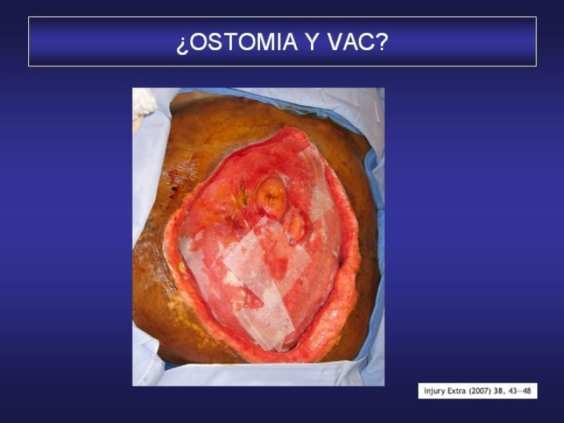 Diapositiva 54 de El Sistema VAC en la laparotomía contenida
