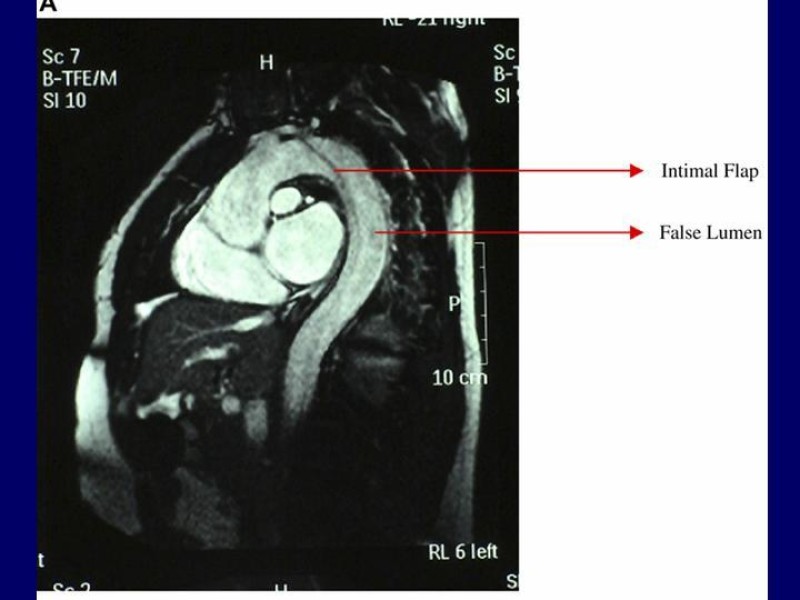 Diapositiva 24 de Disección Aórtica