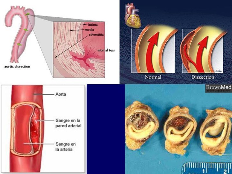 Diapositiva 2 de Disección Aórtica