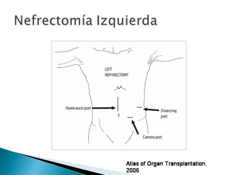 Diapositiva 59 de Técnica de procuramiento renal
