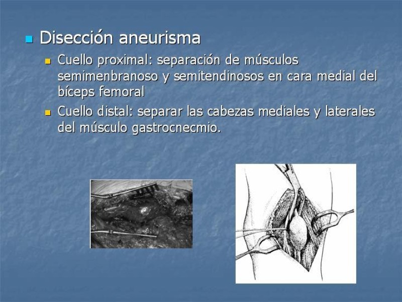 Diapositiva 15 de Aneurisma arterial poplíteo