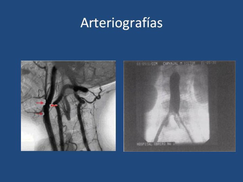 Diapositiva 10 de Fundamentos de la Angiografía