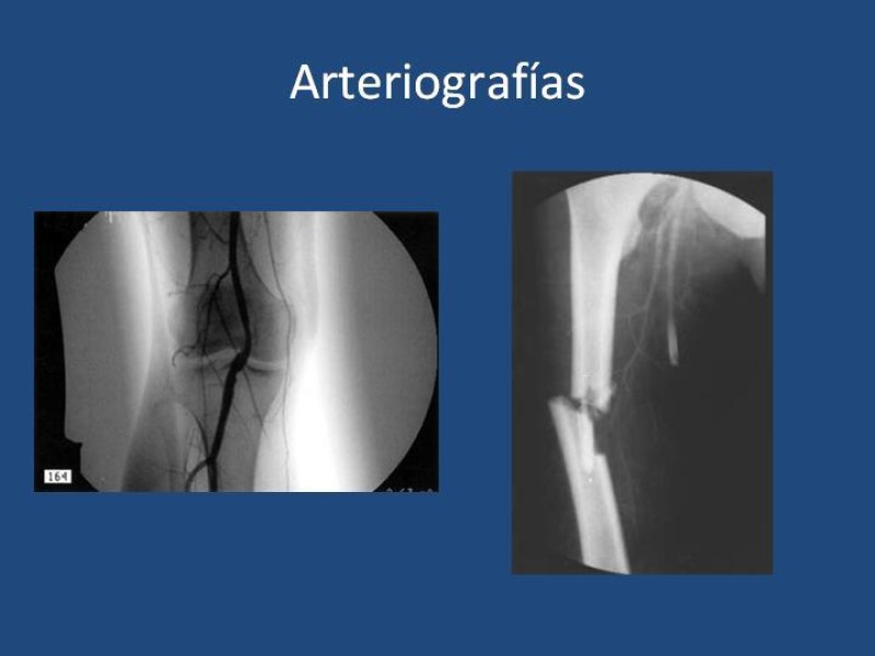 Diapositiva 11 de Fundamentos de la Angiografía