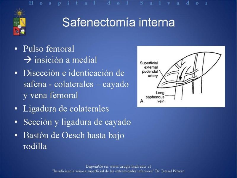 Diapositiva 10 de Ablación de várices en EEII