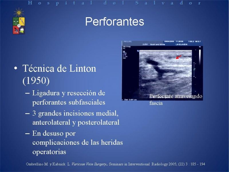 Diapositiva 18 de Ablación de várices en EEII