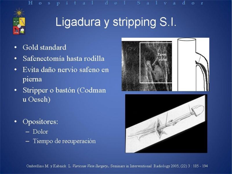 Diapositiva 9 de Ablación de várices en EEII