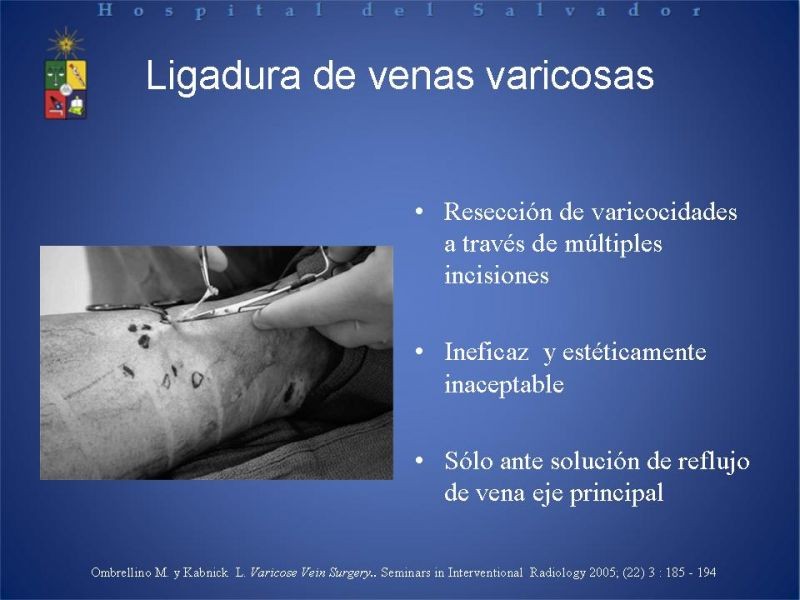 Diapositiva 11 de Ablación de várices en EEII