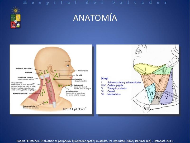 Diapositiva 3 de Adenopatía Cervical