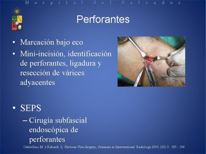 Diapositiva 19 de Ablación de várices en EEII