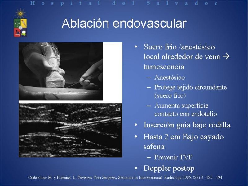 Diapositiva 13 de Ablación de várices en EEII