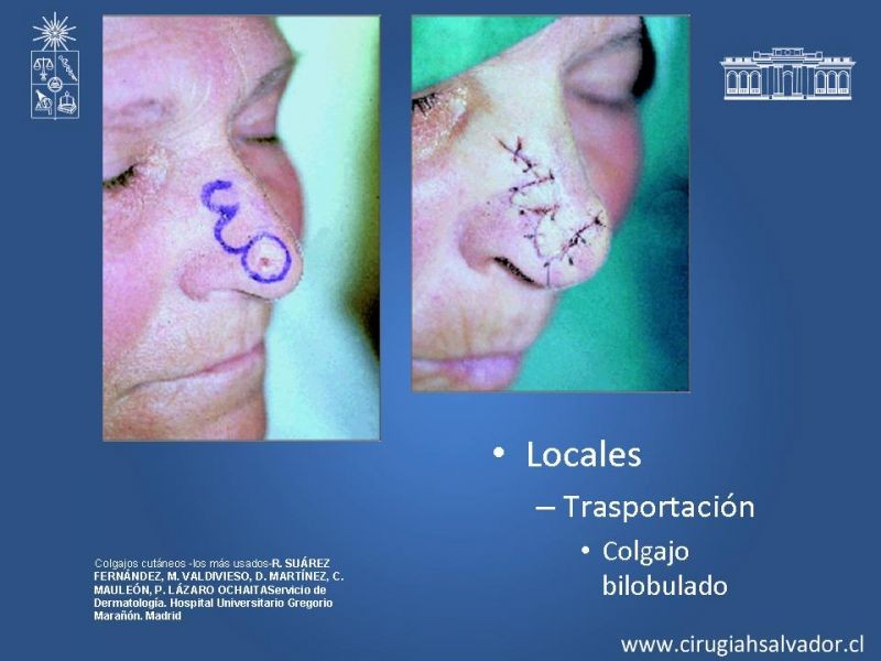 Diapositiva 16 de Colgajos