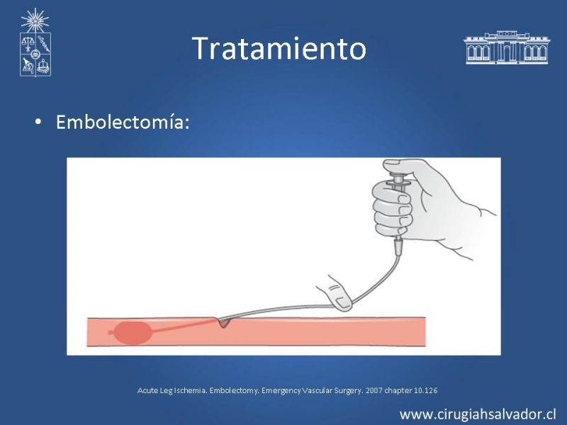 Diapositiva 19 de Isquemia aguda de extremidades