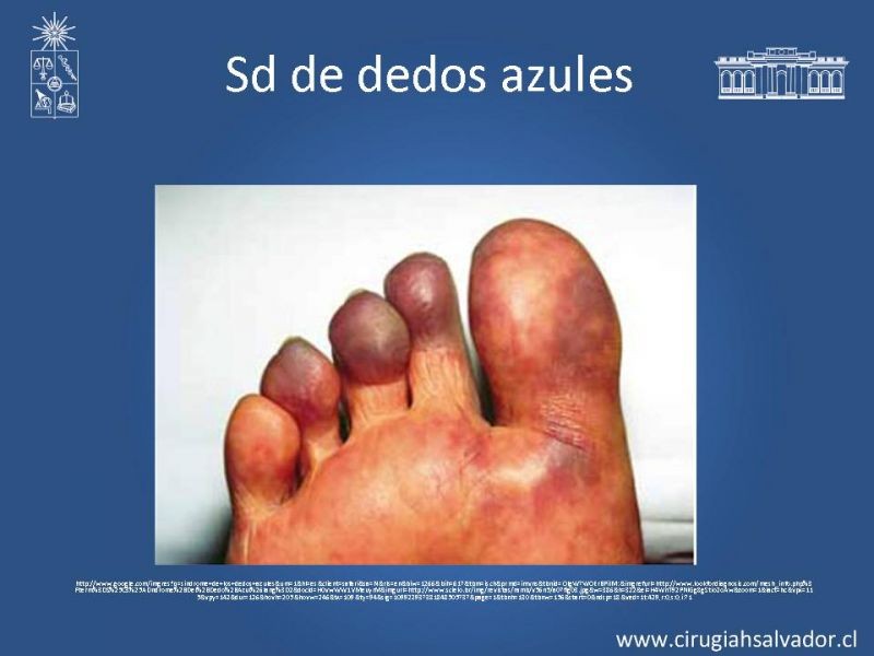 Diapositiva 11 de Isquemia aguda de extremidades
