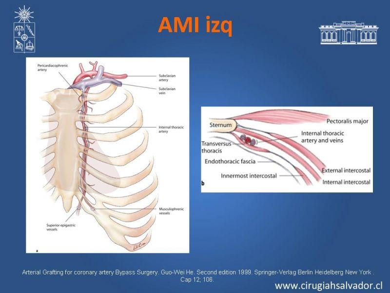 Diapositiva 17 de Revascularización miocárdica con puentes arteriales