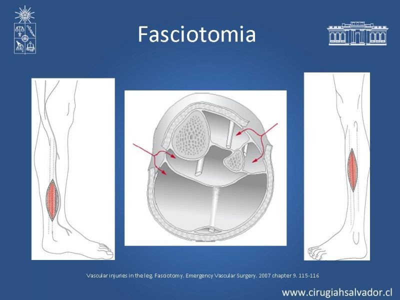 Diapositiva 31 de Isquemia aguda de extremidades