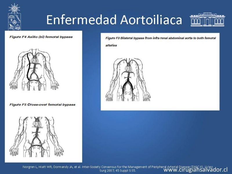 Diapositiva 25 de Enfermedad Arterial Oclusiva Crónica (Tratamiento)