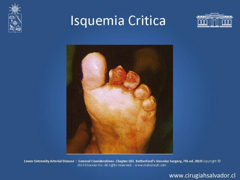 Diapositiva 15 de Enfermedad Arterial Oclusiva Crónica (Epidemiología, Factores de Riesgo, Clínica)
