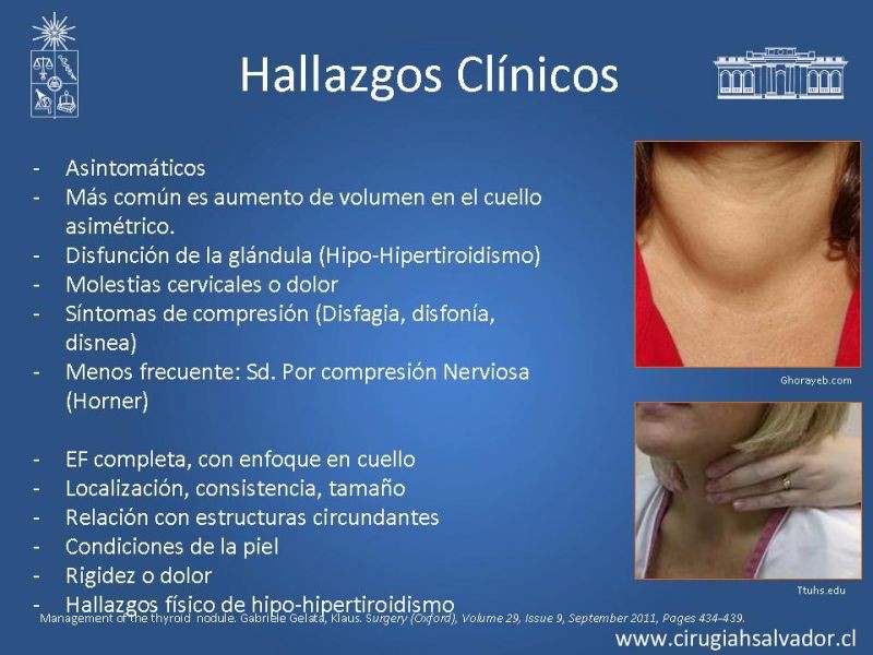 Diapositiva 4 de Nódulo Tiroideo