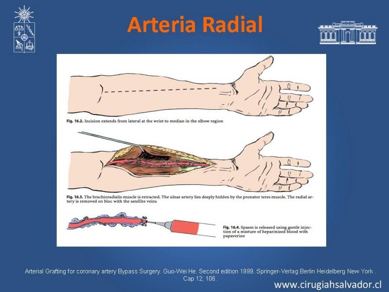 Diapositiva 23 de Revascularización miocárdica con puentes arteriales