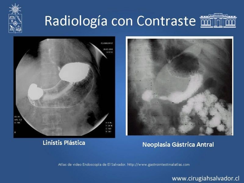 Diapositiva 20 de Cáncer Gástrico: Epidemiología y Diagnóstico