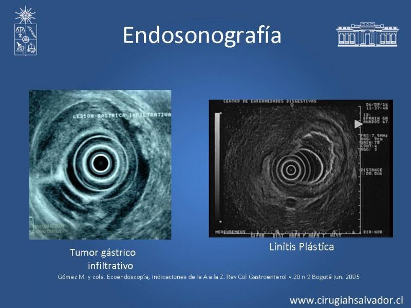 Diapositiva 24 de Cáncer Gástrico: Epidemiología y Diagnóstico