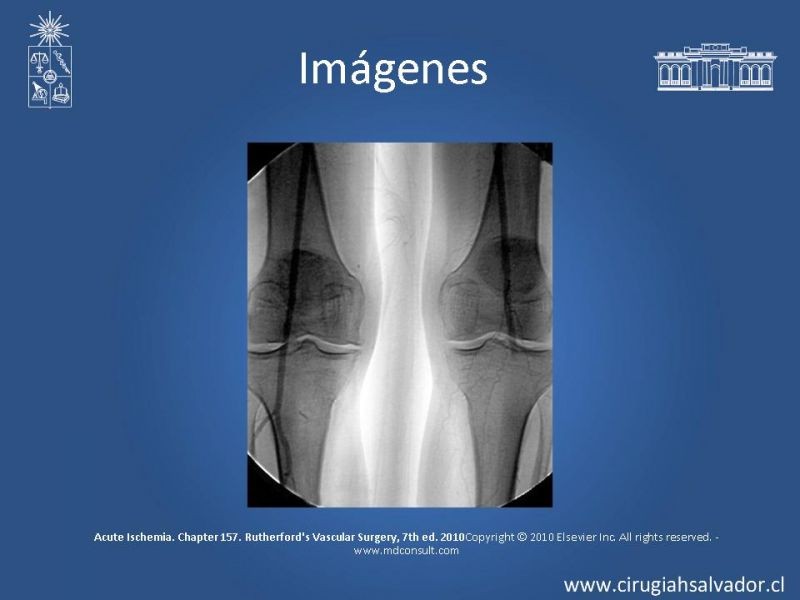Diapositiva 14 de Isquemia aguda de extremidades