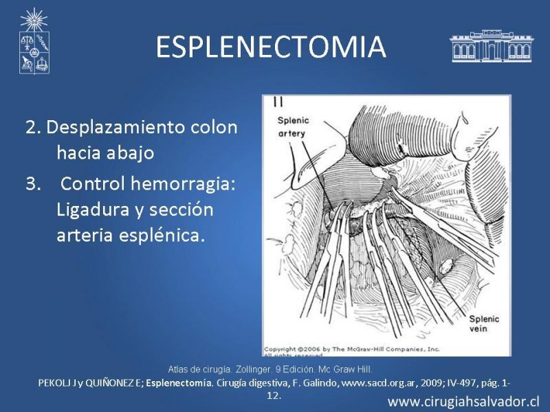 Diapositiva 23 de Abscesos esplénicos