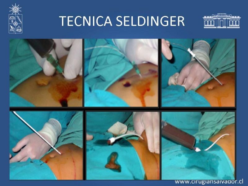 Diapositiva 17 de Abscesos esplénicos