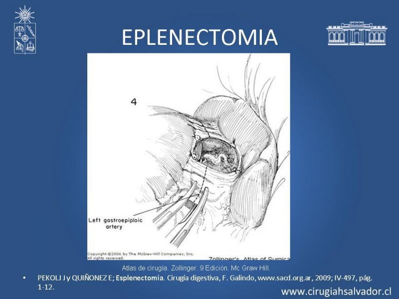 Diapositiva 22 de Abscesos esplénicos
