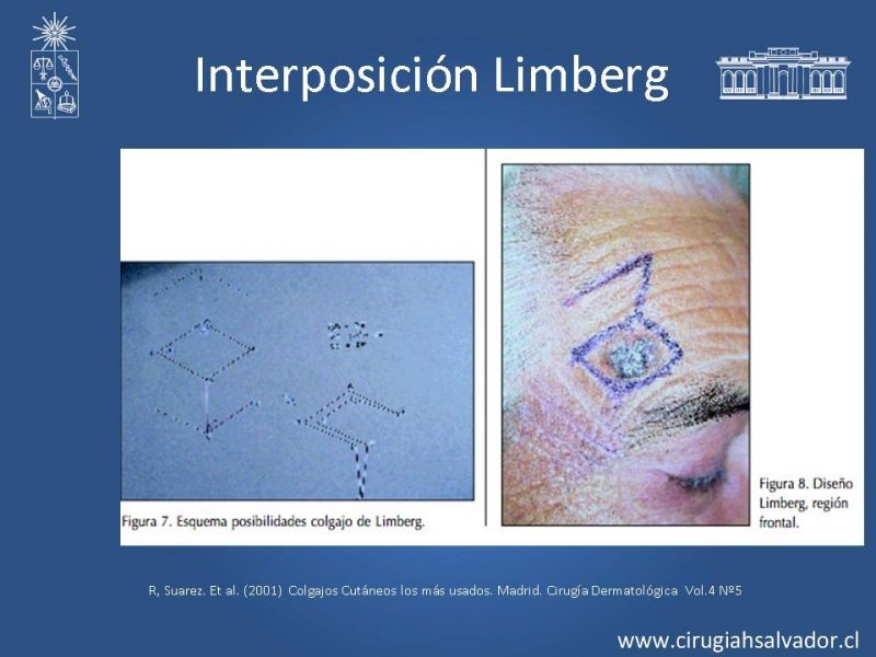 Diapositiva 20 de Colgajos: Generalidades