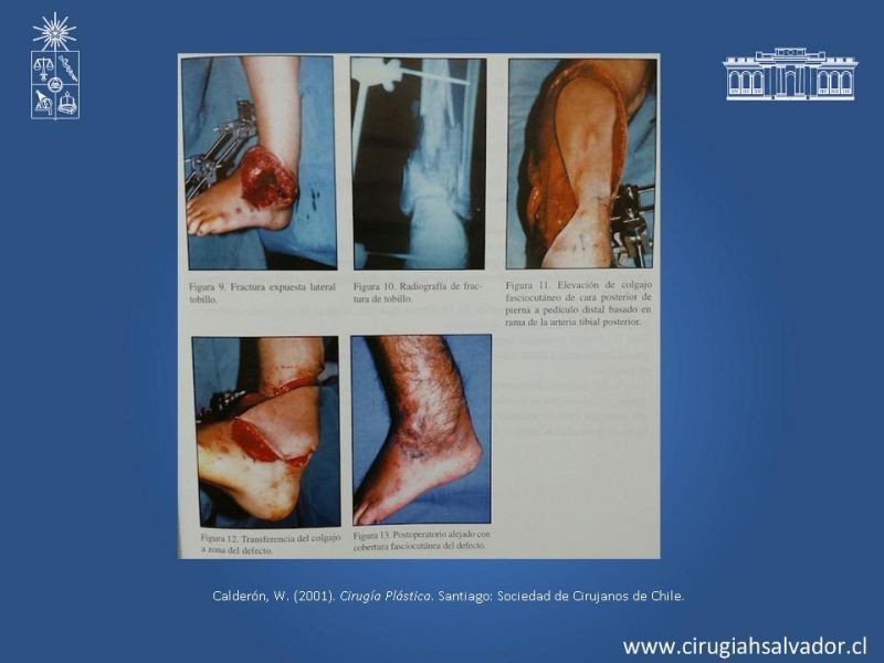 Diapositiva 37 de Colgajos: Generalidades
