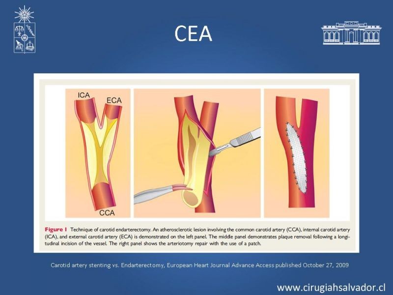 Diapositiva 19 de Estenosis Carotídea Sintomática