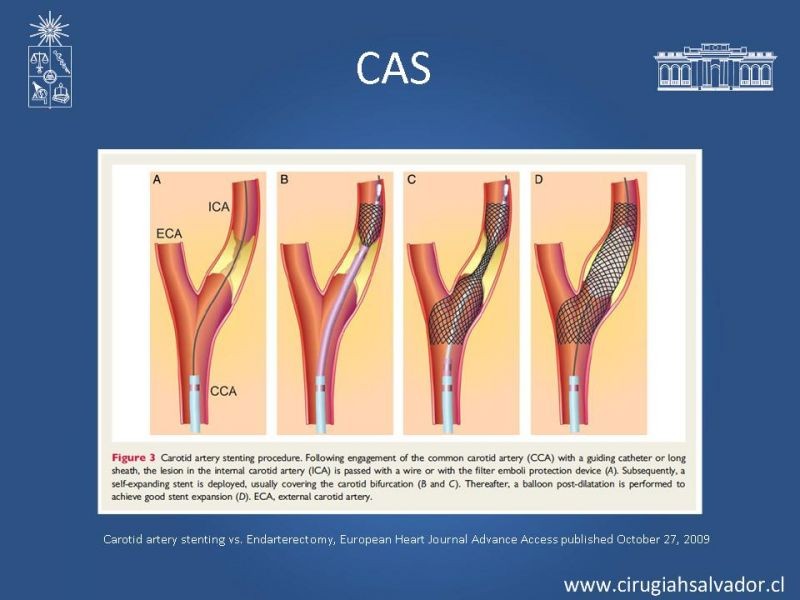 Diapositiva 22 de Estenosis Carotídea Sintomática