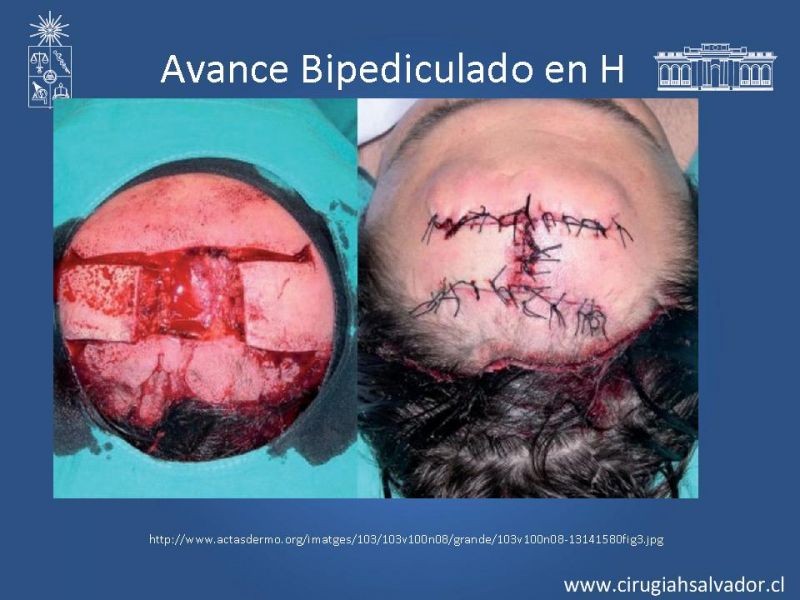 Diapositiva 17 de Colgajos: Generalidades