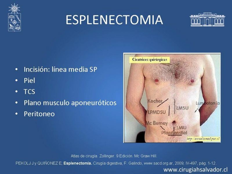 Diapositiva 20 de Abscesos esplénicos