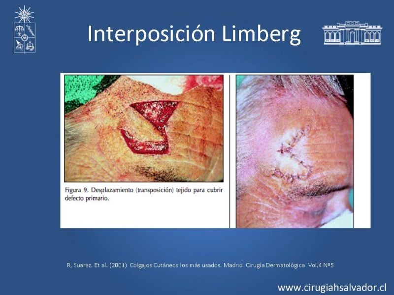 Diapositiva 21 de Colgajos: Generalidades