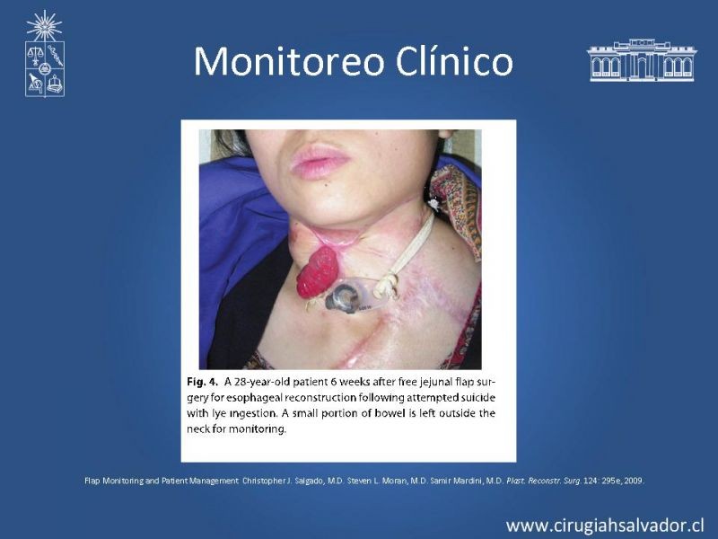 Diapositiva 17 de Monitoreo de Colgajos Libres Microvascularizados