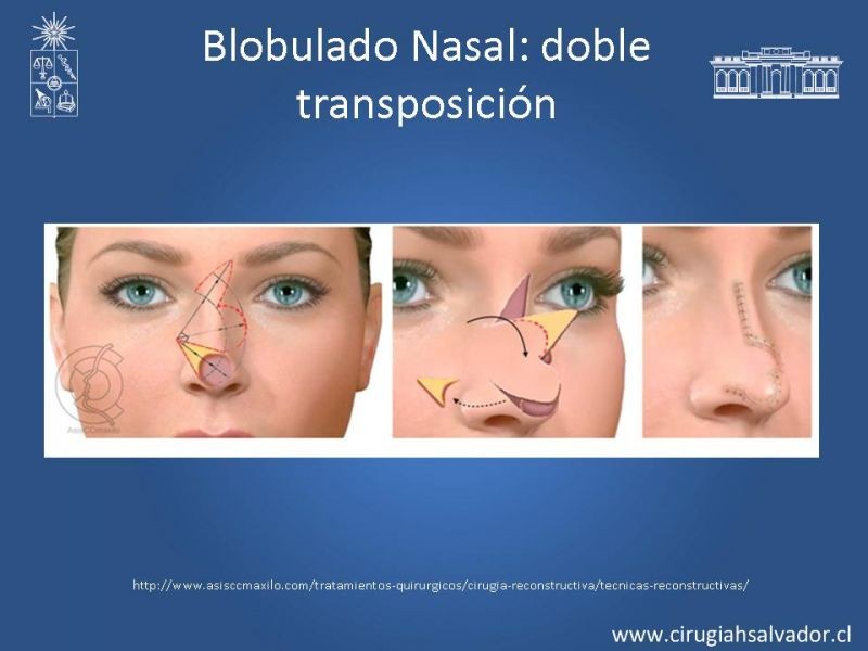 Diapositiva 27 de Colgajos: Generalidades