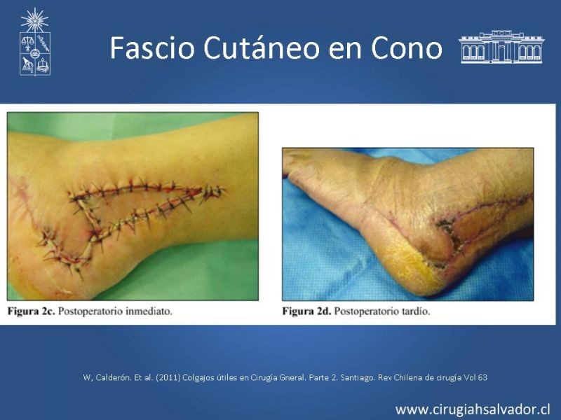 Diapositiva 30 de Colgajos: Generalidades