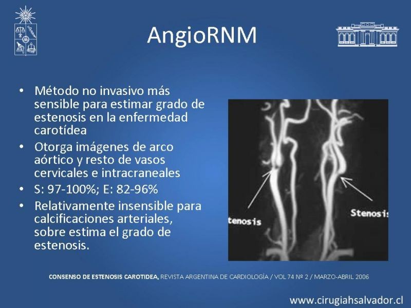 Diapositiva 9 de Estenosis Carotídea Sintomática