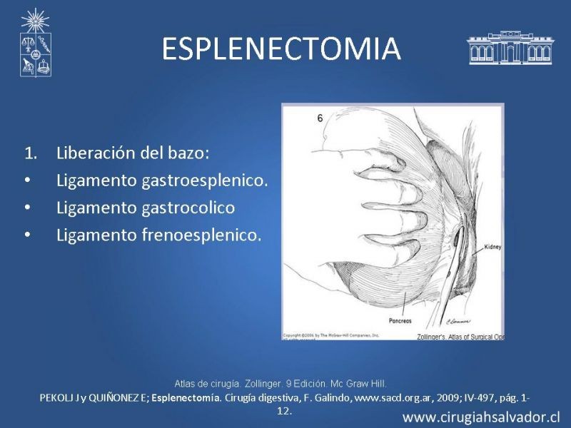 Diapositiva 21 de Abscesos esplénicos